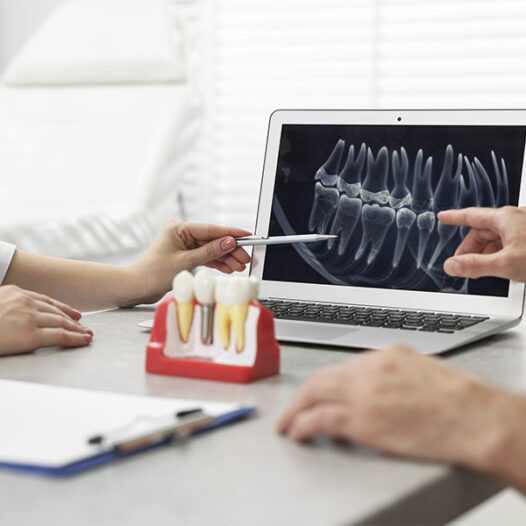Aftercare and Maintenance of Dental Implants