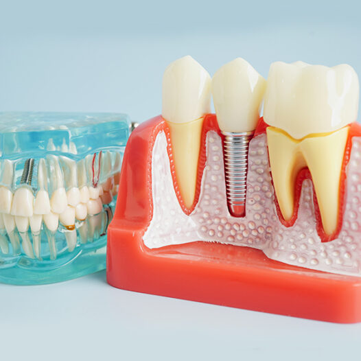 How to Care for Your Dental Implants: Expert Tips from Richmond Dental Care