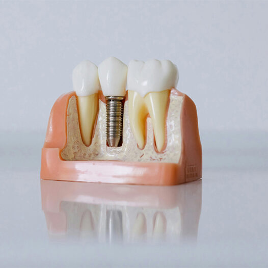 Who Is the Right Candidate for Dental Implants? What You Need to Know